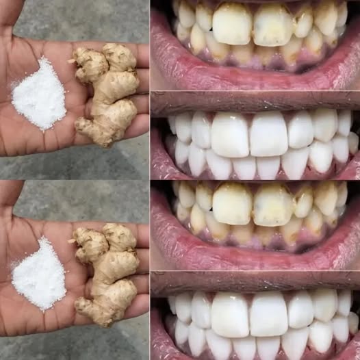 Remove years of stains! In Just few days of using it turn yellow teeth to white like pearls with this recipe…